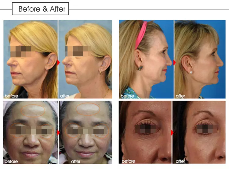 Quick Effect 9D Hifu Skin Tightening Machine For Sag Removal