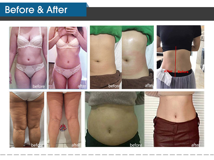 1060nm Cryolipolysis Slimming Machine 4 Handles Diode Laser Slimming Machine