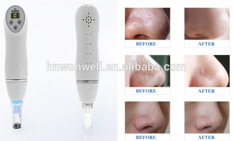 Diamond microdermabrasion machine for removal the aging keratin