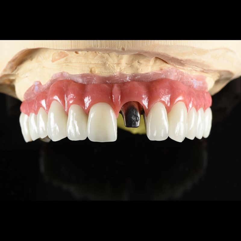 Fixed Restorations Full Arch Zirconia Implant Bridge Denture Teeth