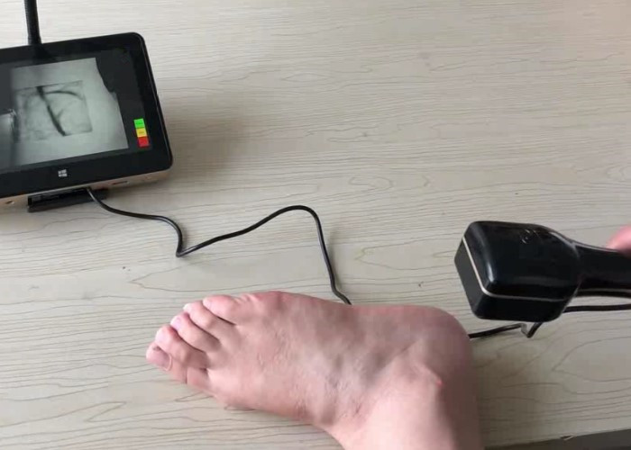 Portable Economical Infrared Vein Finder Detecting About 10mm Depth of Vein Trolley Available