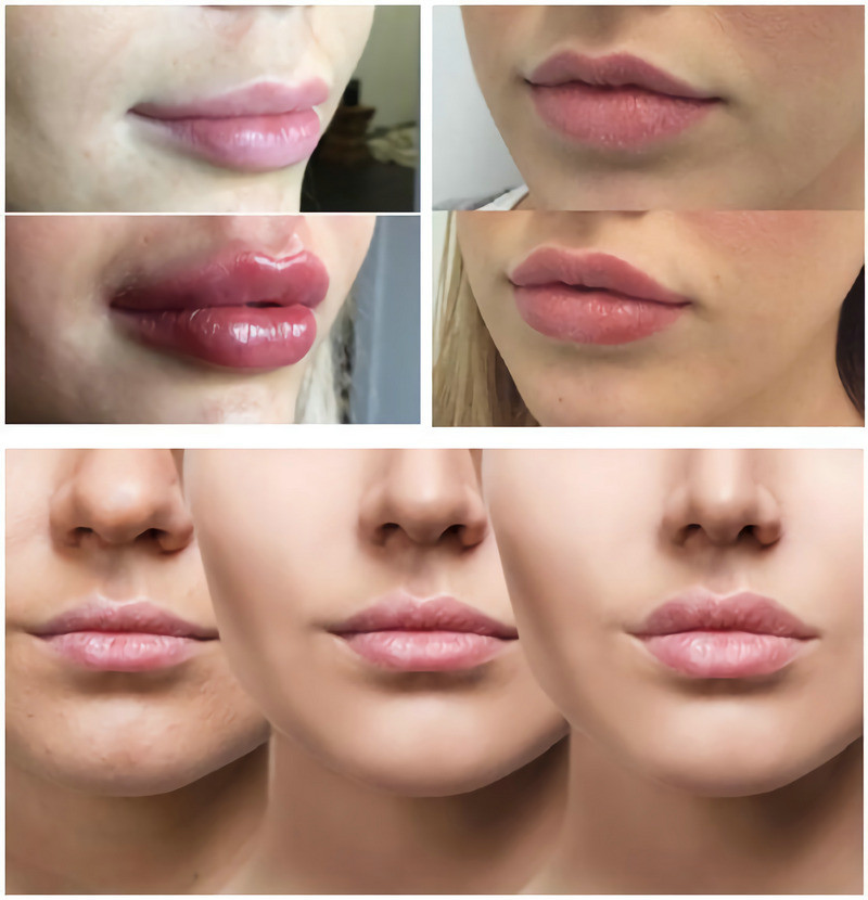 Injectable Hyaluronic Acid Wrinkle Fillers Smooth Outlines Wrinkles Shape Facial Contours Add Lips Volume
