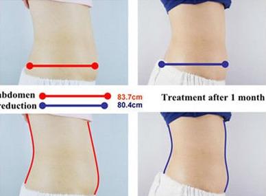 5 handles Vacuum+Cryo, Cavitation and RF multifunctional Cryolipolysis slimming machine