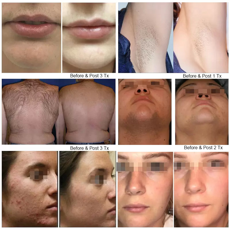 Permanent 3 Wavelengths 808nm Diode Laser Hair Removal Machine Skin Rejuvenation