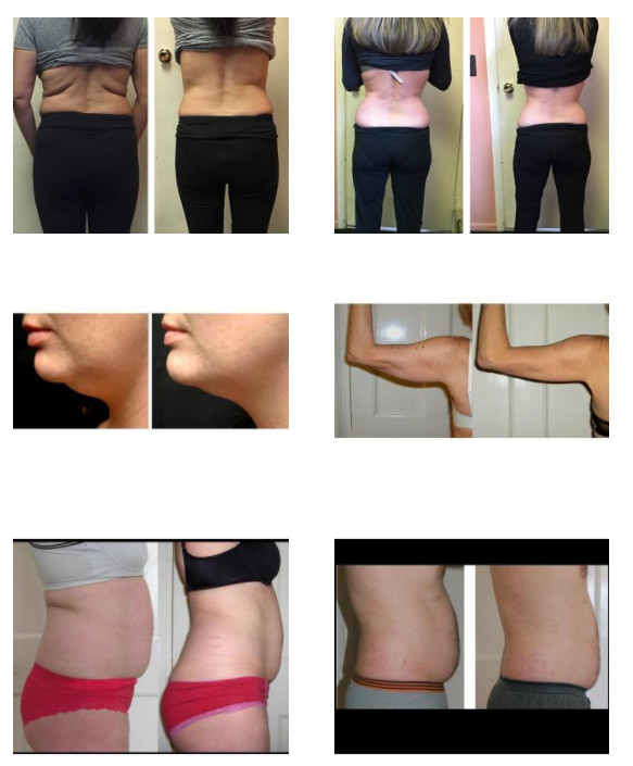 800W 3 Handles Cryolipolysis Body Slimming Machine