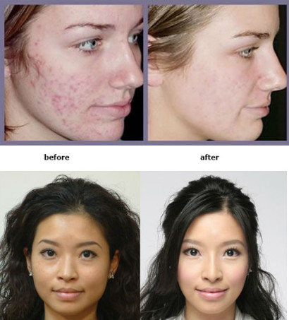 Skin Rejuvenation Oxygen Jet Peel Machine For Wrinkle / Acne Removal