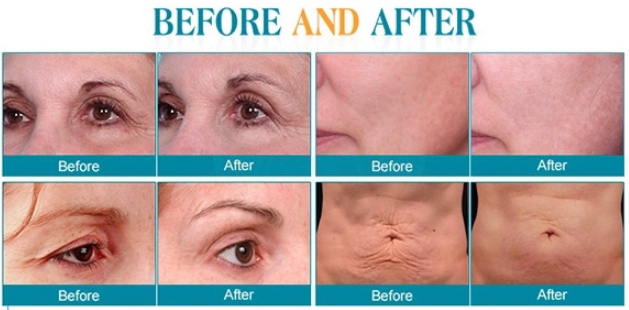 Professional Fractional Microneedle Face Lifting Rf Microneedling Machine