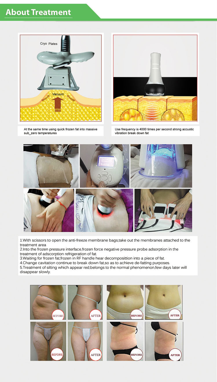LF-236 hot sale 4 in 1 Cryo+RF+cavitation+lipo laser cryolipolysis freezing slimming machine