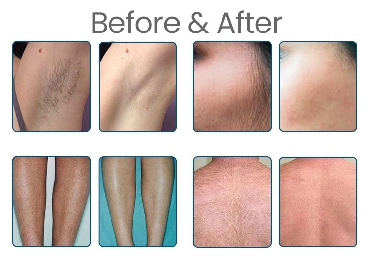 All Type Skin Painless 1064 755 808nm Diode Laser Hair Removal Machine