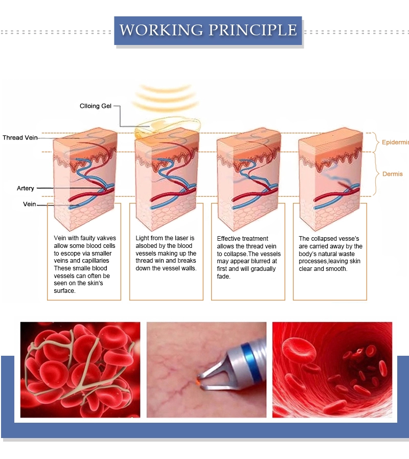 EVLT 0.5mm 980nm Diode Laser Vascular Removal Machine