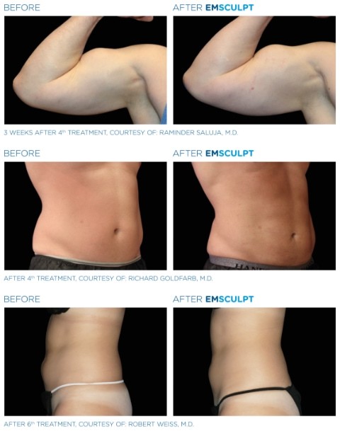 Muscle Build Skin Tightening EMS EMShapeing Machine