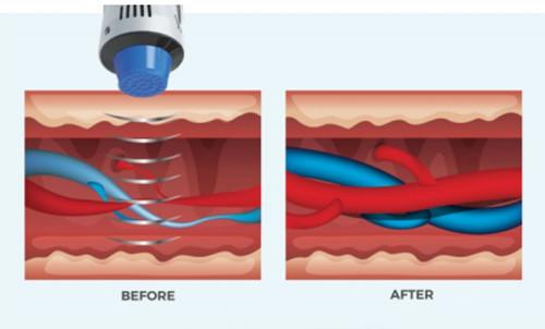 Vacuum Shock Wave Physiotherapy Machine For Cellulite Reduction