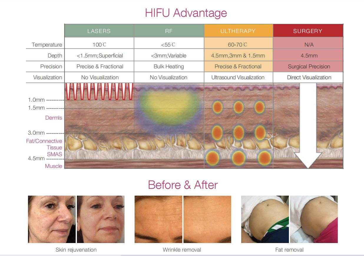 5 In 1 Smas Face And Neck Lift HIFU High Intensity Focused Ultrasound Machine