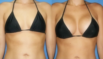 Personal Care 10ml Hyaluronic Acid Breast Filler To Increase Breast Size