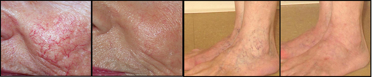 laser varicose vein removal treatment 980nm laser vascular removal machine portable