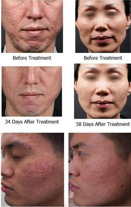 RF Scar removal microneedle rf beauty device For Wrinkle Removal / Skin Tightening