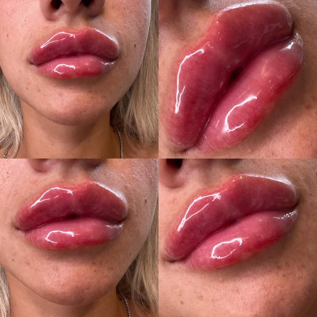 Lip Hyaluronic Acid Dermal Filler Juvederm Ultra3 Voluma Injection