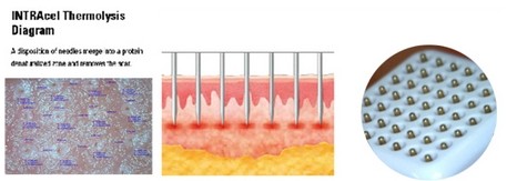 RF Scar removal microneedle rf beauty device For Wrinkle Removal / Skin Tightening