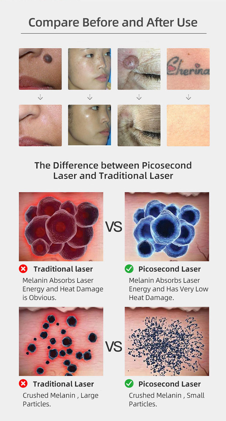 Led Peeling 100 - 240V 9 Gears 8W Picosecond Laser Pen