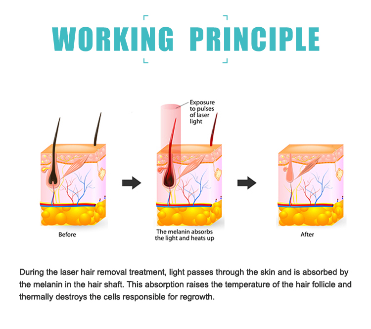 Hair Removal Diode Triple Wavelength Laser , 808 755 1064 Alexandrite Laser Machine