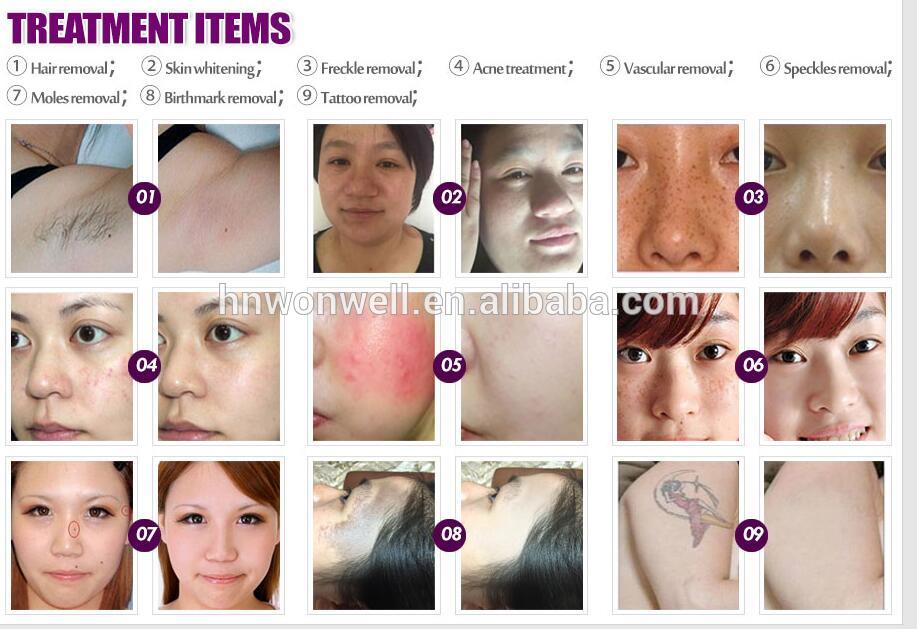 Super Quality Unique SHR IPL+Yag Laser+Fractional RF 4 in1 best beauty equipment