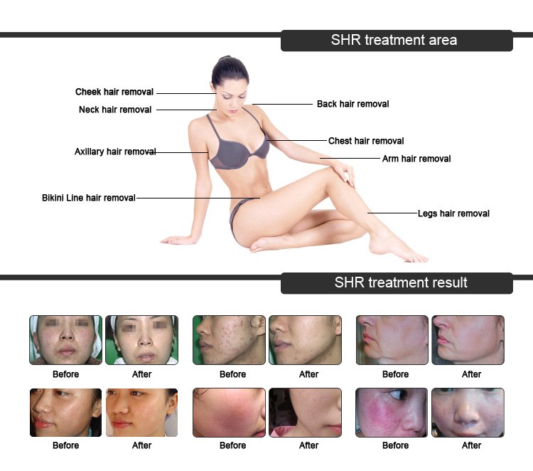 USB IPL Hair Reduction Machine , Intense Pulsed Light Hair Removal Machine OEM / ODM