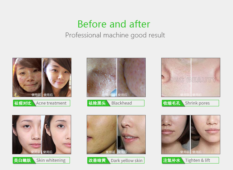 3 In 1 Oxy Peel Machine Removes Wrinkles Blackhead Revitalizes The Skin Facial Device