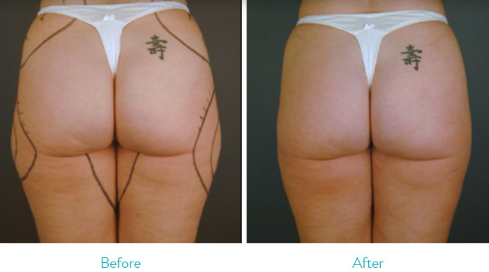 High Vaccum Surgical Buttocks Liposuction Machine Power Assisted For Hospital