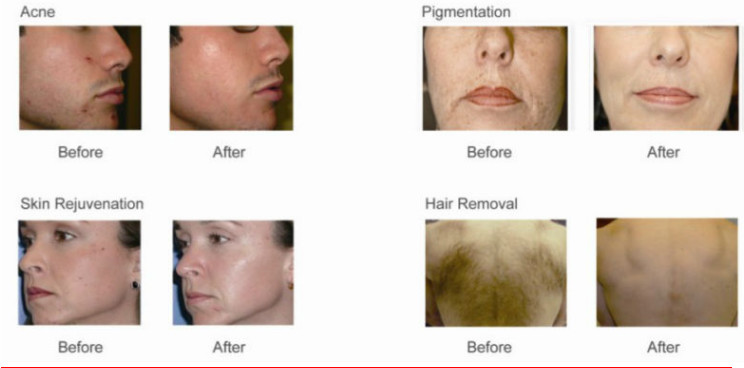 980nm Wavelength Laser Vascular Removal Machine For Facial Spider Vein Removal