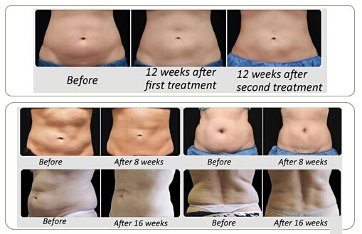 Cryolipolysis nubway for weight loss portable home cryolipolysis liposuction machine