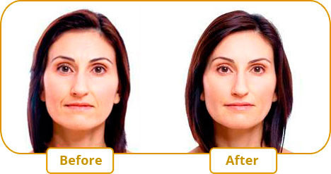 Fosyderm CE Hyaluronic Acid Cross Linked Dermal Filler For Lips Up 24mg/Ml