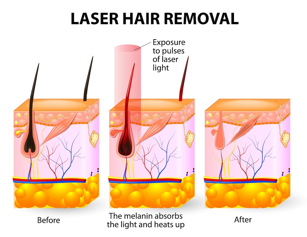 808nm diode laser facial hair removal for women/laser body hair removal/permanent hair removal