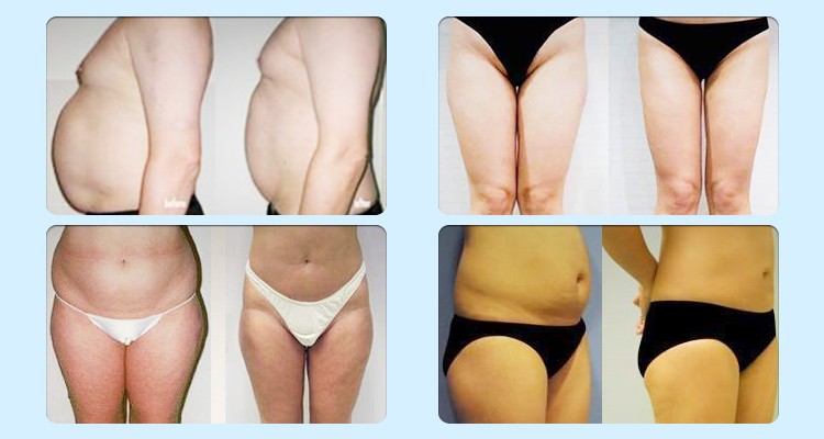 Small Size RF Cavitation Fast Slimming Machine Weight Loss For Salon
