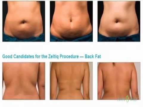Body Shape Sculpting Cavitation Vacuum Slimming Machine