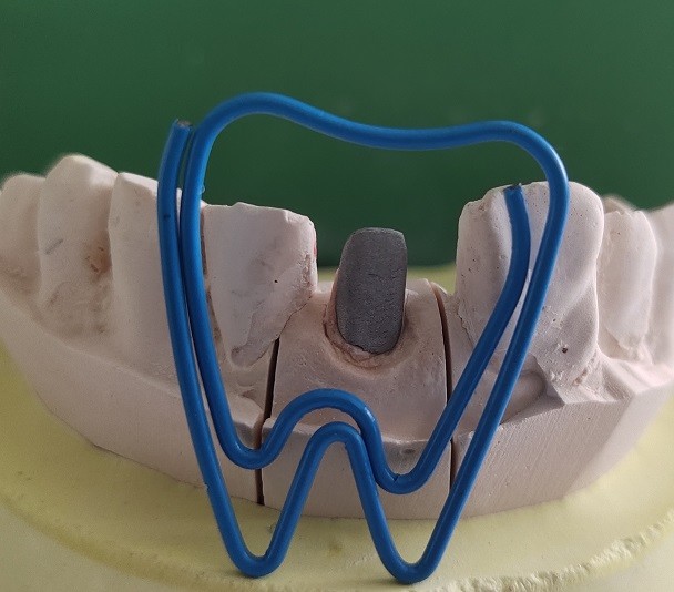 Metal Dental Post And Core After Endodontic Treatment