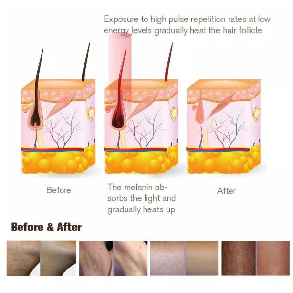 Dual Heads 7 Filters Ice Ipl Laser Hair Removal Machine Portable Hair Remover