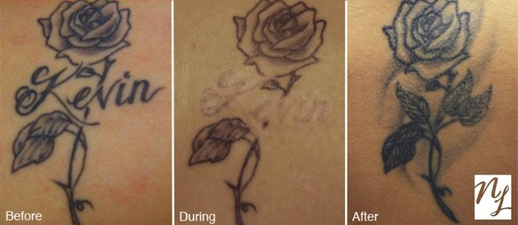 Professional q switched nd yag laser tattoo removal machine with CE approved 1064nm/532nm