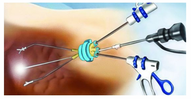 RF Plasma Gyn Electrode , Disposable Probe