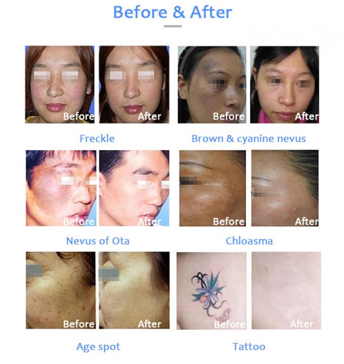 Honkon Picosecond Laser Tattoo Removal Skin Problems Treatment Beauty Machine With Less Pih 1