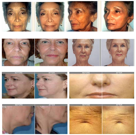 Fractional RF Skin Tightening Machine / Striae Gravidarum removal