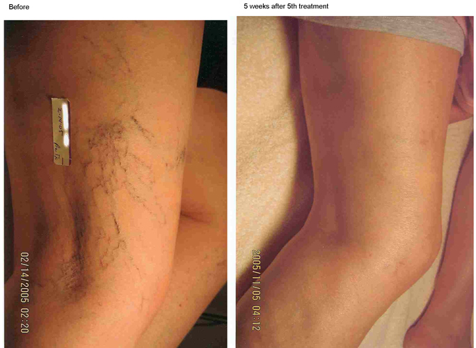 Medical 980nm diode laser spider vein removal/980nm diode laser/980nm medical laser