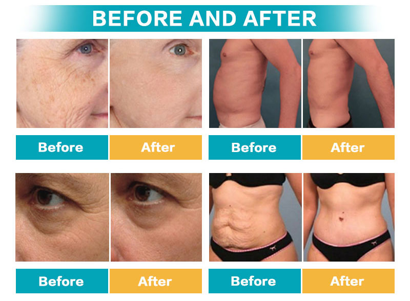 Anti Aging HIFU Slimming Machine Skin Care 7D Non Surgical Liposuction