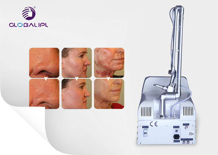 Vaginal Tightening Co2 Fractional Laser Machine Scar Removal 33.3hz Frequency