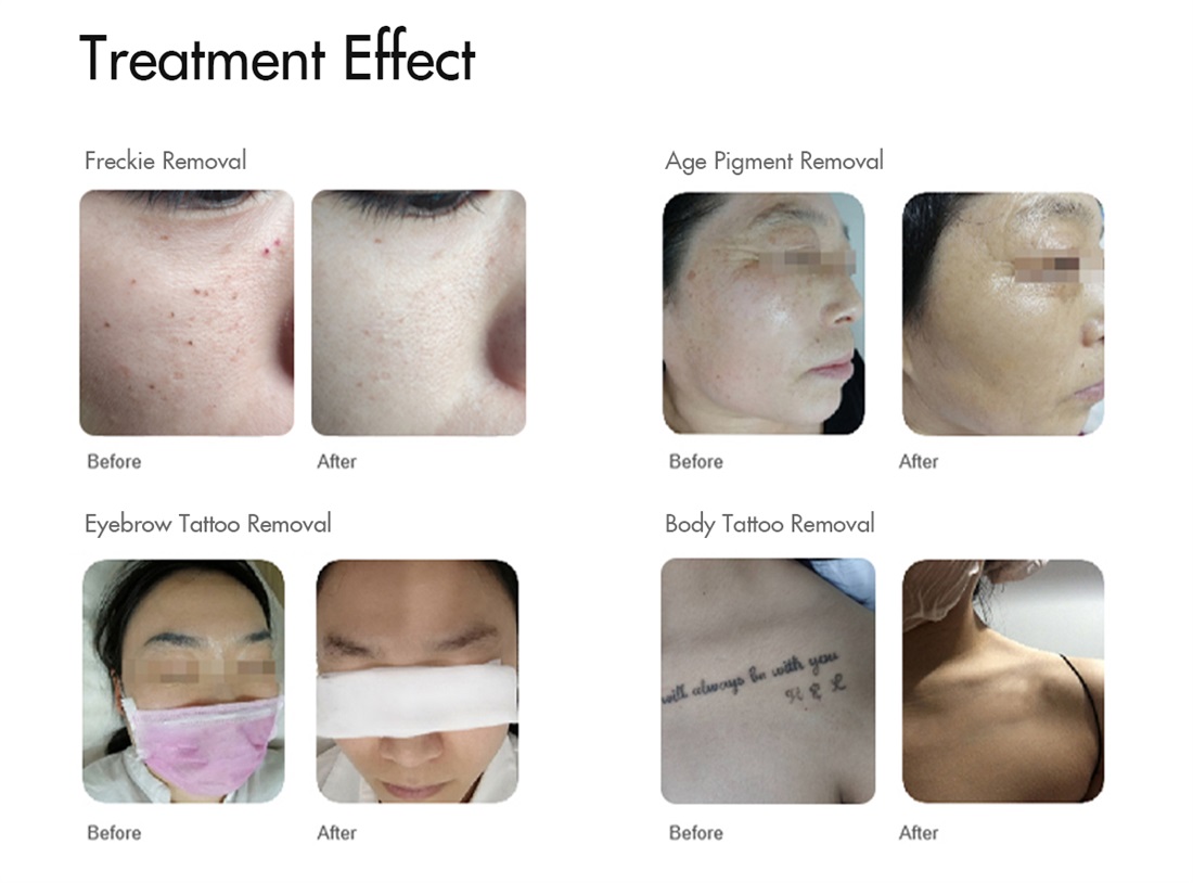High Power Q Switched Nd Yag Laser Tattoo Removal Pigment Removal Machine With 532Nm 1064Nm
