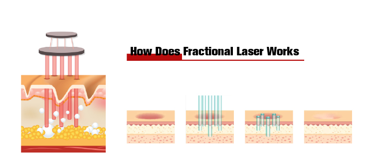Skin Smoothing Fractional Laser CO2 Machine , Stationary Skin Resurfacing Machine