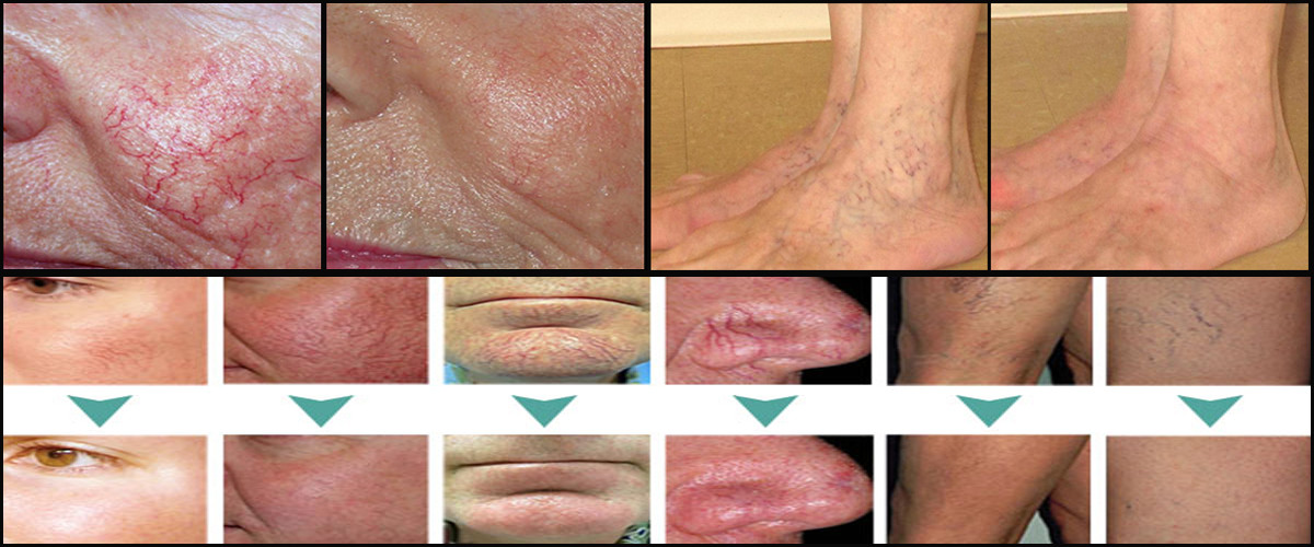 Spider vein laser removal Laser varicose vein removal treatment