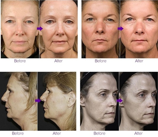 rf face lift.jpg