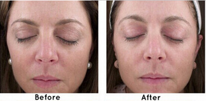 Mini Supersonic 3D HIFU Machine 3MHZ Effective Non Invasive For Skin Tightening