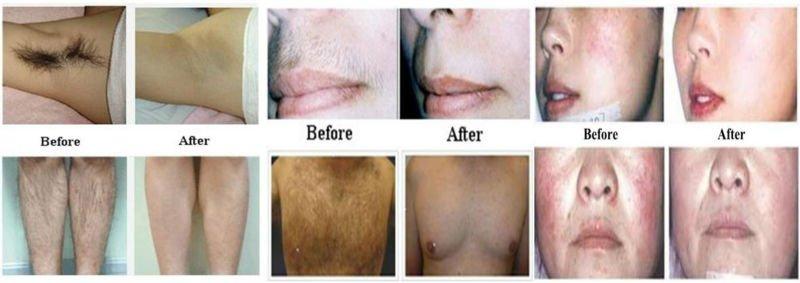 Painless remove hair permenantly! Strong power 808 nm diode laser hair removal machine