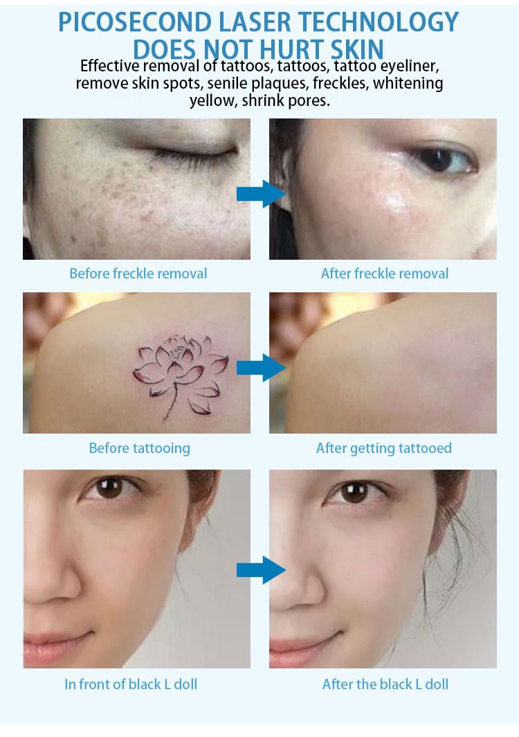 Medical Q Switched Nd Yag Laser Machine , Beauty Laser Tattoo Removal Machine